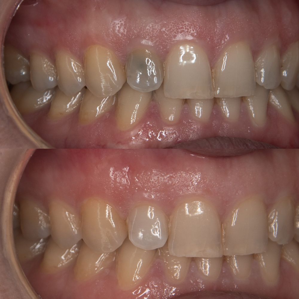 Devital Bleaching — tedavi öncesi ve sonrası